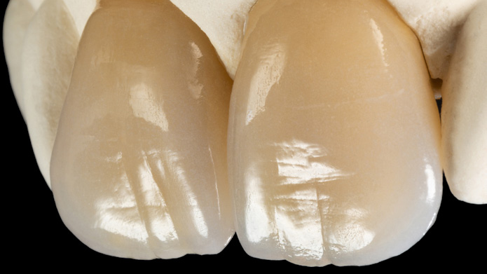 rams dental lab classic zirconia crown